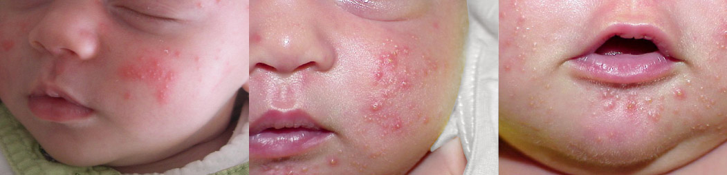 初心者の両親は気をつけてください！赤ちゃんによく見られる発疹の識別とケア edenswearのブログ